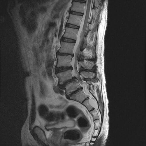 Espondilolistesis en columna vertebral