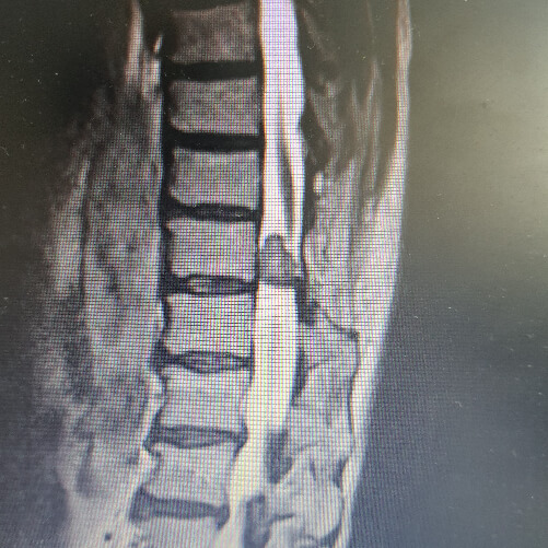 Tumores de la columna vertebral