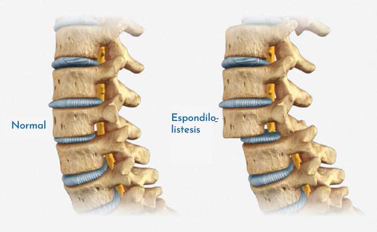 Espondilolistesis